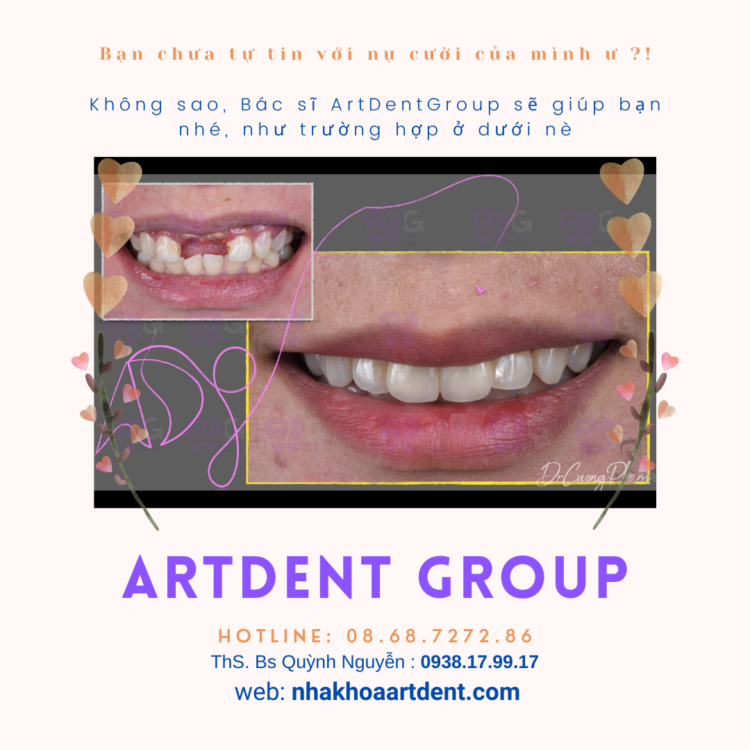 artdent-veneer-su-mat-dan-su