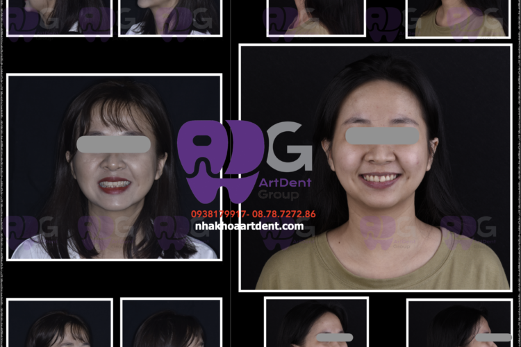 Niềng răng chen chúc, hô