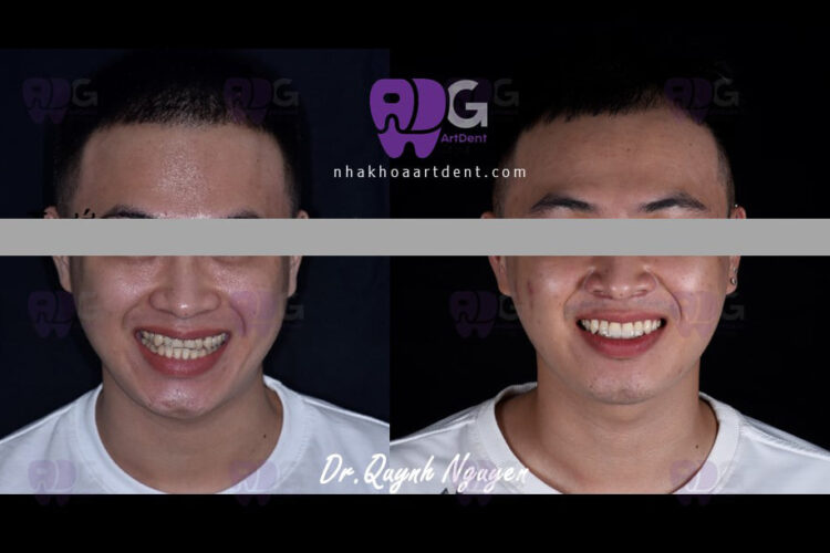 Niềng răng chen chúc, móm, chuẩn nụ cười Hollywood