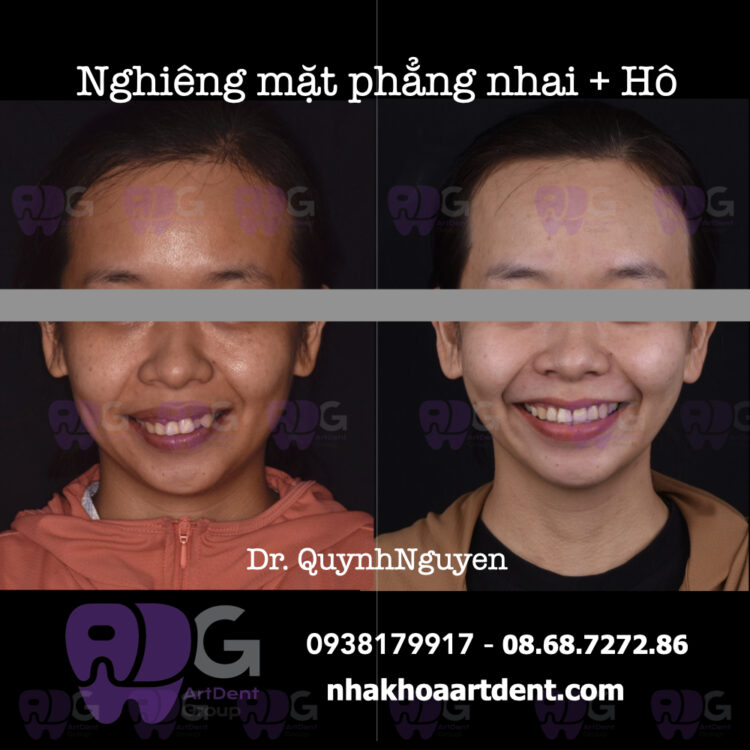 Nieng_rang_chinh_nha_ho_nghieng_mat_phang_nahi